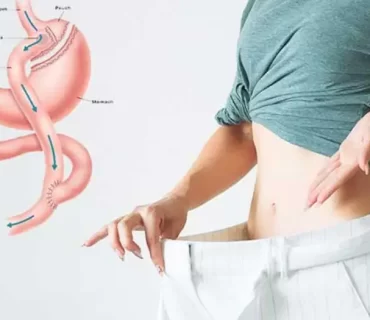 Gastrik Mide Bypass Faydaları