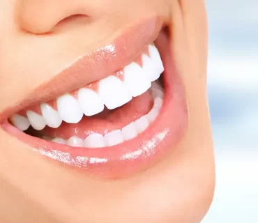 Hollywood Smile nedir?