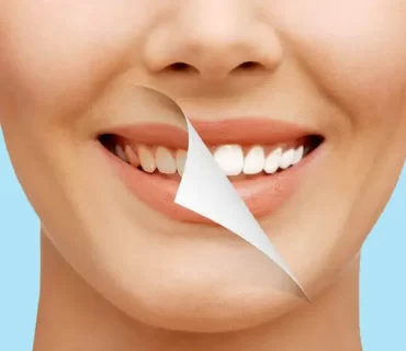 Hollywood Smile Sonrası Bakım