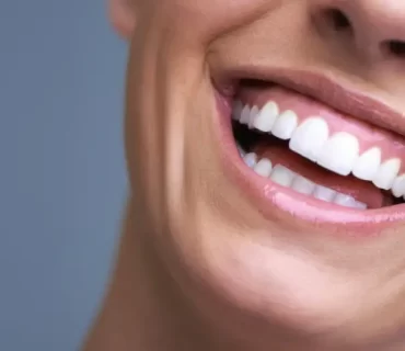 Hollywood Smile İçin Uygulama Süreci