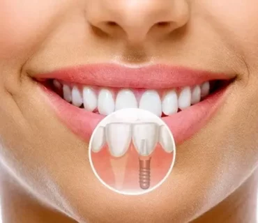 Dental İmplantlardan Kaynaklanan Yan Etkilere Karşı Alınabilecek Önlemler