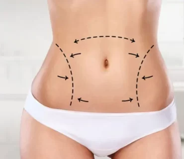 Karın germe ile liposuction arasındaki fark nedir?